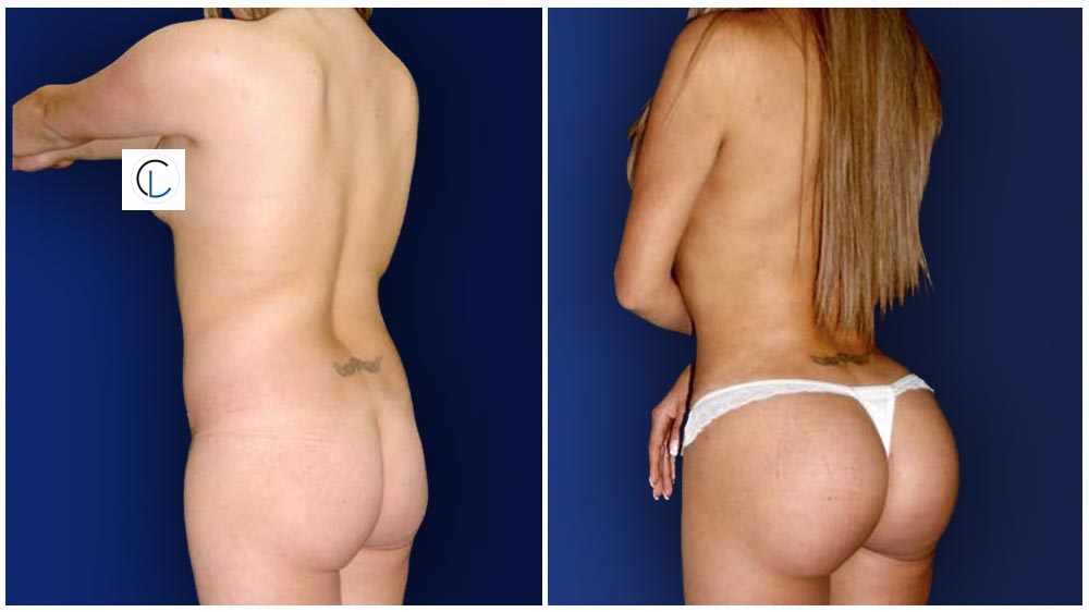 Fat Transfer to Buttocks Patient (34 years)